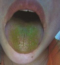 吃瓜后舌头黑,揭秘黑色现象背后的秘密